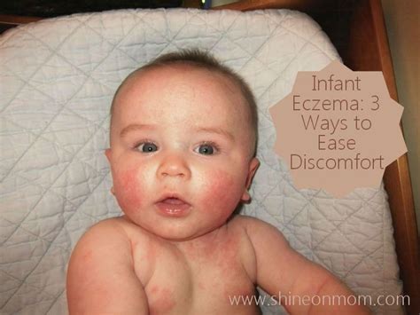 Infant Eczema 3 Ways To Help Ease Discomfort Baby Eczema Eczema