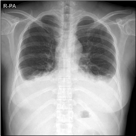 Chest X Ray Showing Bilateral Pleural Effusion And Pulmonary Venous