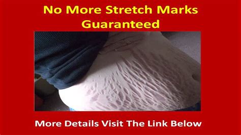 How To Remove Stretch Marks Permanently Youtube