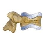 Osteoporosi e Vertebre | Vertebroplastica Percutanea
