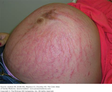 Chapter 75 Pruritic Urticarial Papules And Plaques Of Pregnancy The