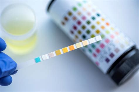 Gene Based Urine Test Detects Monitors Bladder Cancer Retail Brief Africa