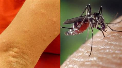 Why Do Mosquito Bites Itch 7 Ways To Treat Mosquito Bites And Stop The