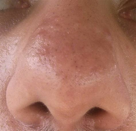 Skin Concerns Raised Bumps From Old Acne That Just Wont Go Away R