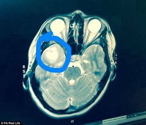Scans Reveal A Golf Ball Sized Tumor On Alberta Canada Teenagers