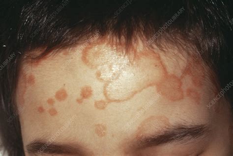 Ringworm Stock Image M2700223 Science Photo Library