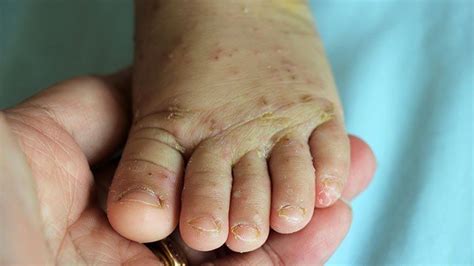 How To Know If That Rash Is Scabies Everyday Health
