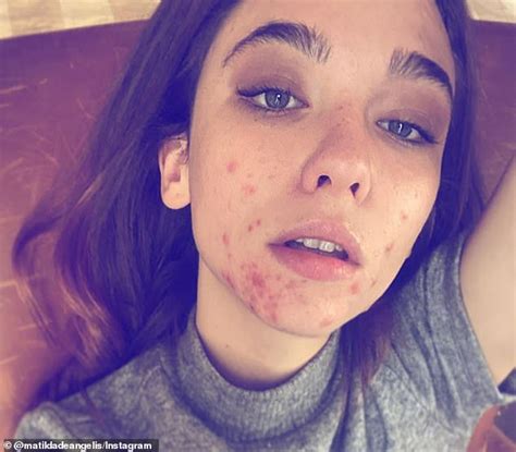 The Undoings Matilda De Angelis Shares Image Of Her Skin Being Eaten