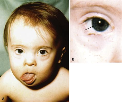 In another medical condition, peroxisomal disorder, a flat nasal bridge came with the associated epicanthal. Flat Nasal Bridge And Epicanthal Folds - Trisomy 21 Docx Autism Down Syndrome : It is very ...