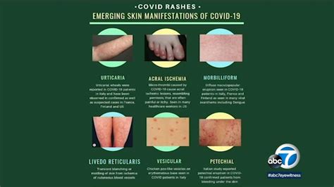 Coronavirus Symptoms Dermatology Organization Issues Guidance On Skin
