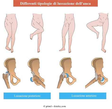 Lussazione d'Anca: i Sintomi e gli Esercizi di Riabilitazione