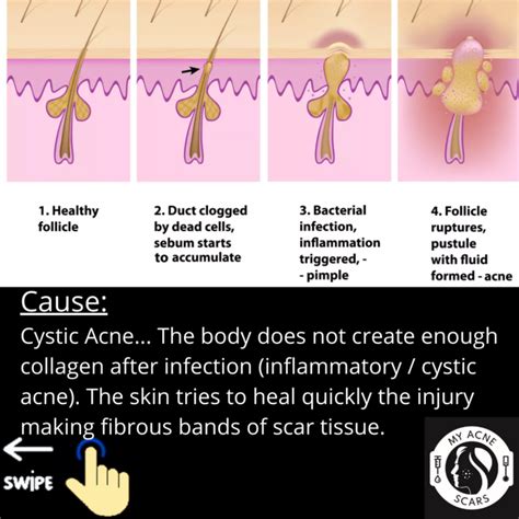 Rolling Acne Scars Overview My Acne Scars