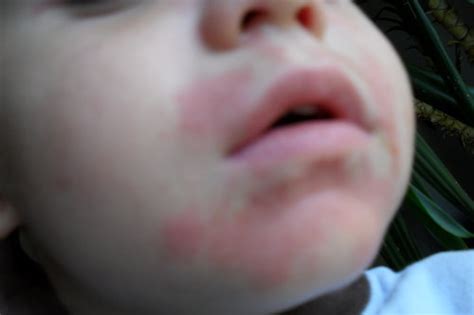 Toddler Allergic Reaction To Foods And Eczema Babycenter