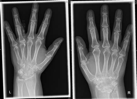 Thu0141 Severely Destructive Unilateral Wrist Arthritis As A Rare