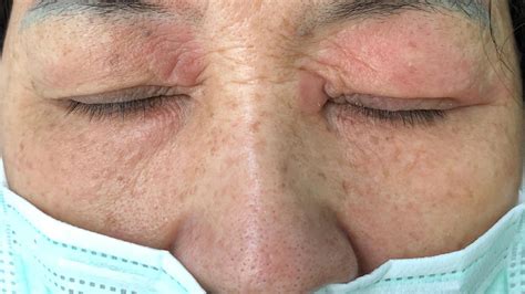 Eyelid Dermatitis Treatments Symptoms Causes And More