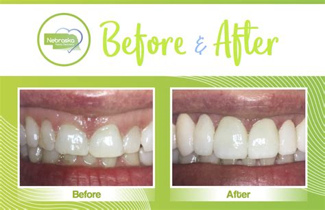 Teeth Reshaping Love Your Smile Again Northstar Dental