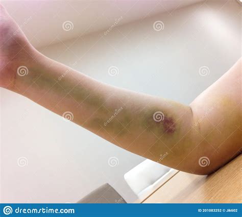 Bruises On Woman Arm Stock Photo Image Of Injury Pain 201083252