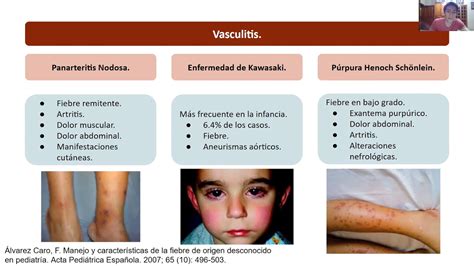 Fiebre De Origen Desconocido Pediatría Youtube