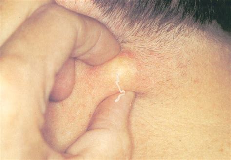 Epidermoid Cyst Medical Pictures Info Health