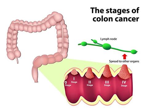 How Many Stages Of Colon Cancer Cancerwalls