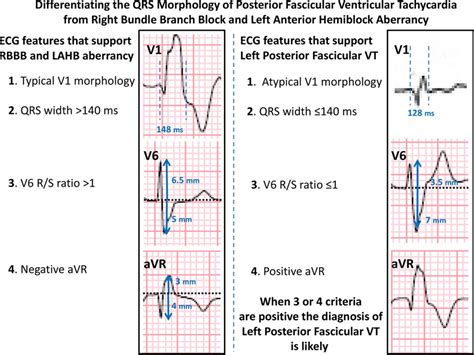 Differentiating The Qrs Morphology Of Posterior Fascicular Ventricular