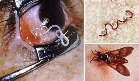 The Most Shocking Parasites Ever Found Living Inside The Human Body