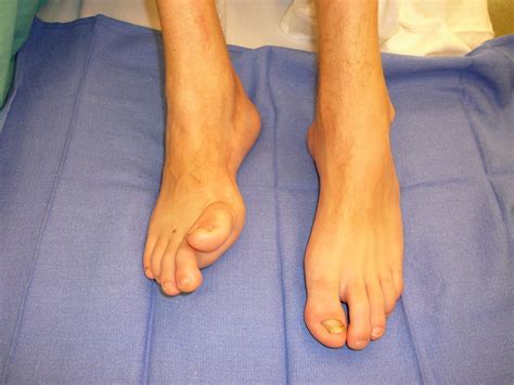 Brachymetatarsia Advanced Foot And Ankle Center Of San Diego