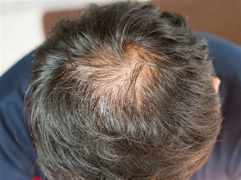 Male Pattern Baldness Treatment And Causes Guides