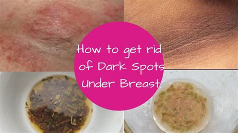 How To Get Rid Of Dark Spots Under Breast And Underarm How To Get Fair