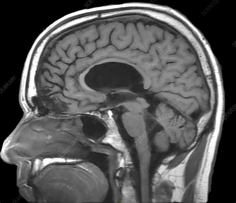 Chronic Post Traumatic Brain Injury Mri Stock Image C0306063
