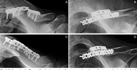 Figure 1 From Orthogonal Double Plate Fixation For Long Bone Fracture