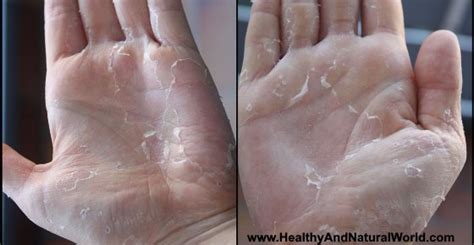 Peeling Skin On Hands Or Fingers Causes And Effective Treatments