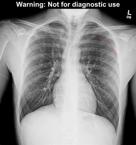 Pneumothoraces) refers to the presence of gas (often air) in the pleural space. Pneumothorax