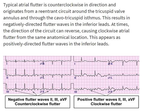 Atrial Flutter Types Cardiology Medbabe Ekg Flutter Images