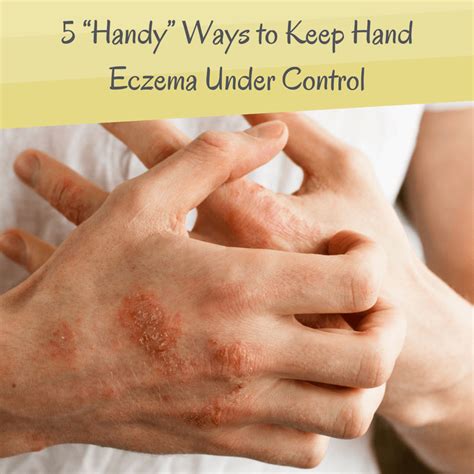 5 Handy Ways To Keep Hands Eczema Under Control Its An Itchy