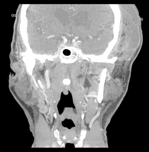 Ct Examination Of Head And Neck Coronal Scan Soft Tissue Window
