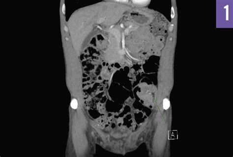 Adult Intussusception Consultant360