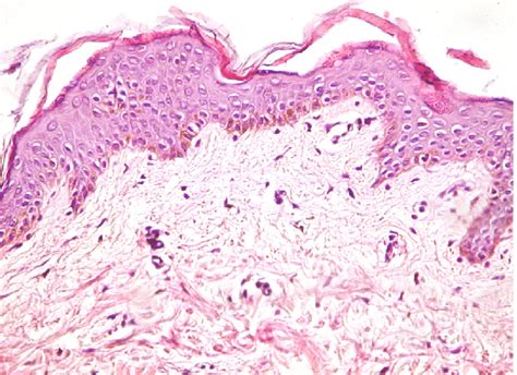 Normal Skin Epidermal Dermal Junction Wavy With Formation Of Rete