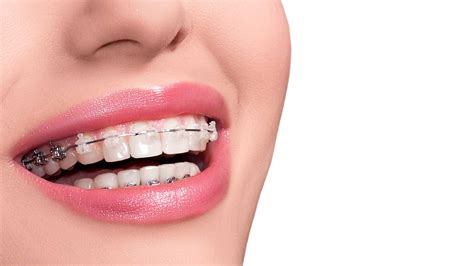 Clear Ceramic Braces Img Top Orthodontist Braces Invisalign