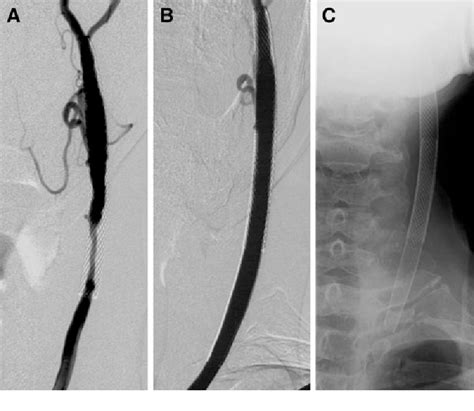 Figure 2 From Carotid Stenting For Radiation Induced Extracranial