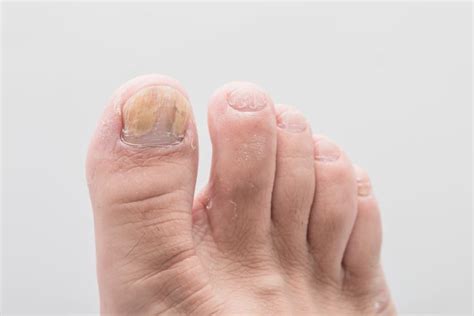 An Overview Of Common Toenail Problems