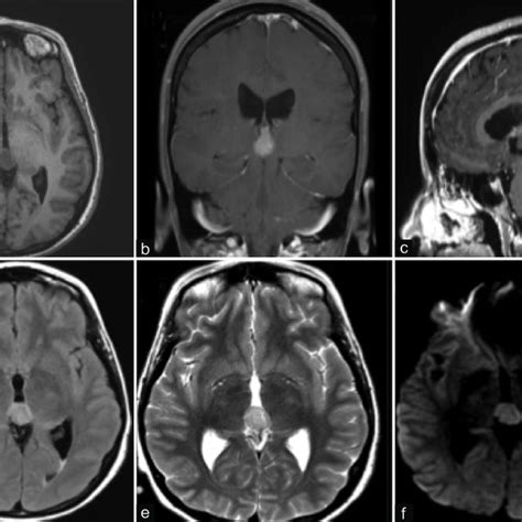 Preoperative Magnetic Resonance Images A Axial T1 Weighted Image