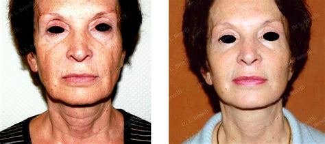photos avant après de chirurgie esthétique du visage