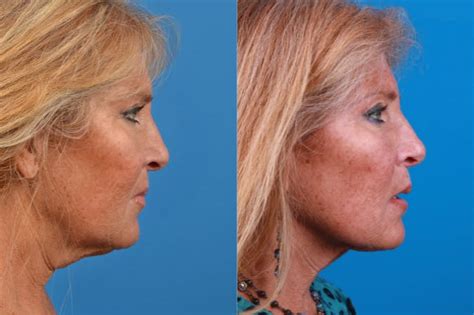 Patient 122406549 Laser Assisted Weekend Neck Lift Before And After