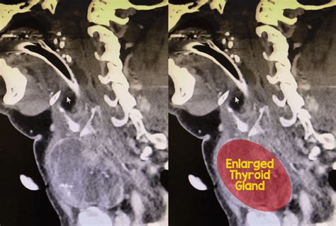 Thyroid Goiter Rebel Em Emergency Medicine Blog