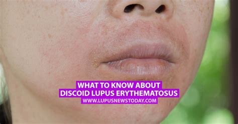 What To Know About Discoid Lupus Erythematosus Lupus