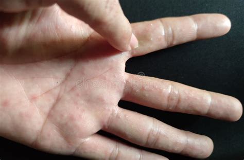Eczéma Dyshidrotique Sur Le Pied Dermatite Blister Traité Avec