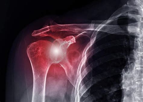 Articular Cartilage Shoulder Injury Orthopedic Shoulder Specialist