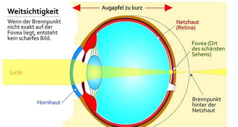 Check spelling or type a new query. Weitsichtigkeit | Optiker erklärt Ratgeber bei Hyperopie