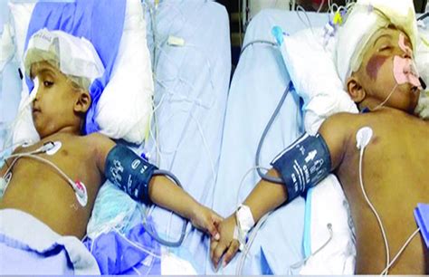 Conjoined Twins Rabeya Rokeya Return Home After Successful Separation